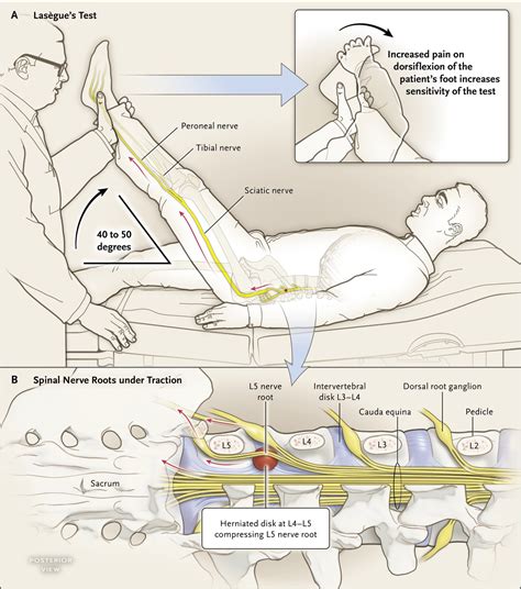 sciatica compression test|diagnosis for sciatic nerve damage.